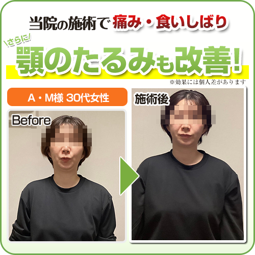 顎のたるみ:ビフォーアフター